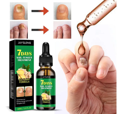 FungiFree™ jengibre🫚 |Tónico Antifúngico para uñas